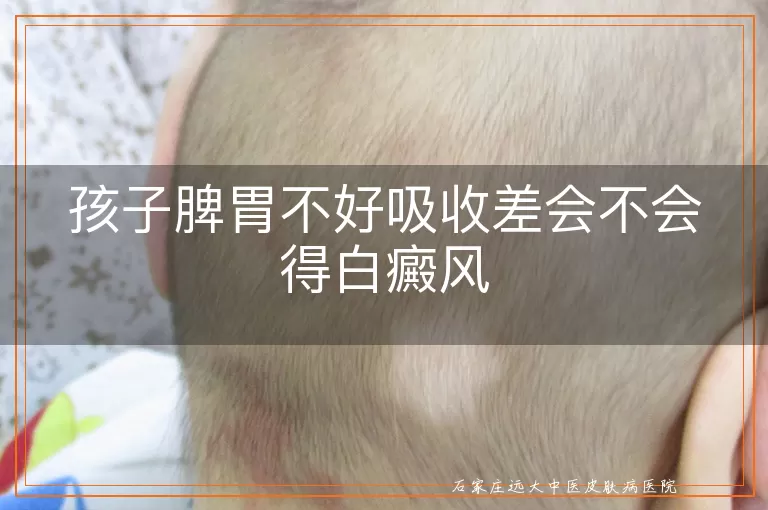孩子脾胃不好吸收差会不会得白癜风
