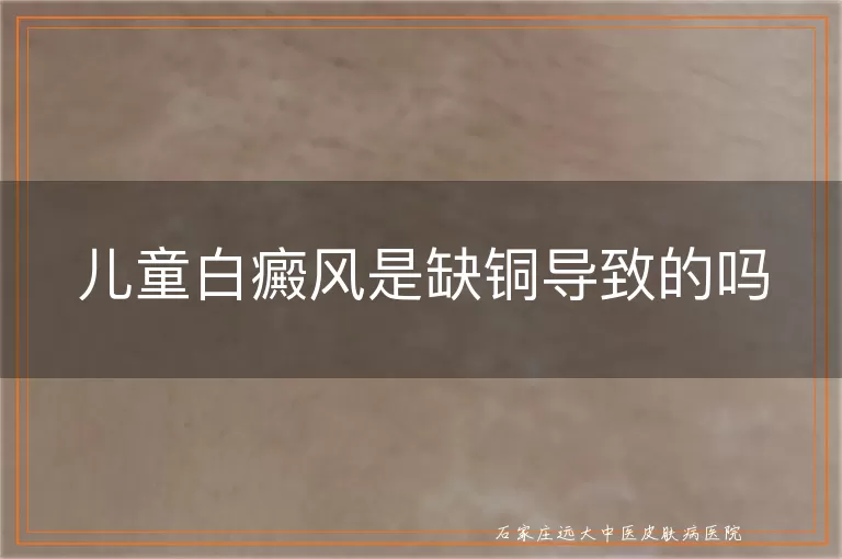 儿童白癜风是缺铜导致的吗