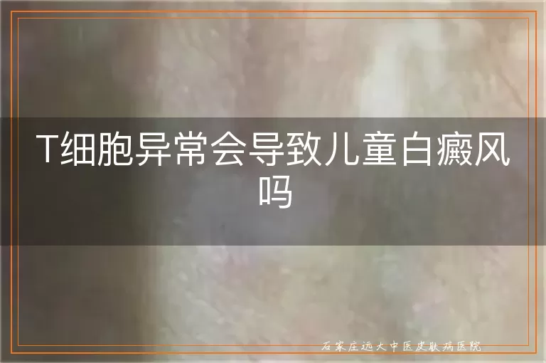 T细胞异常会导致儿童白癜风吗