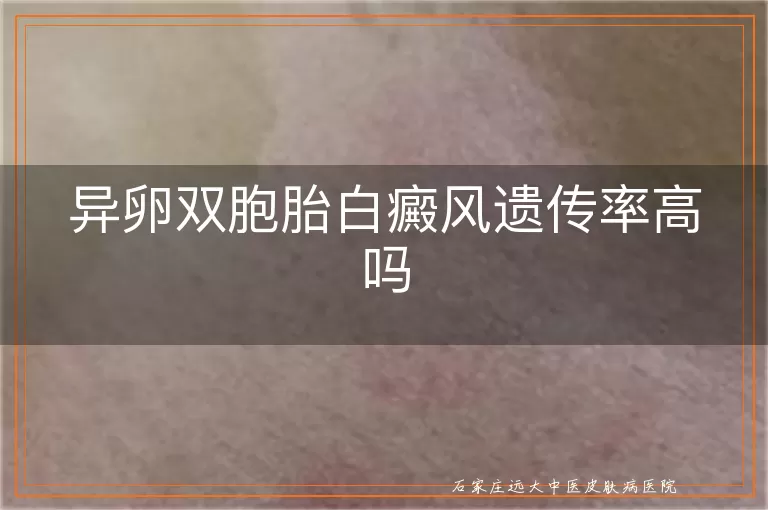 异卵双胞胎白癜风遗传率高吗