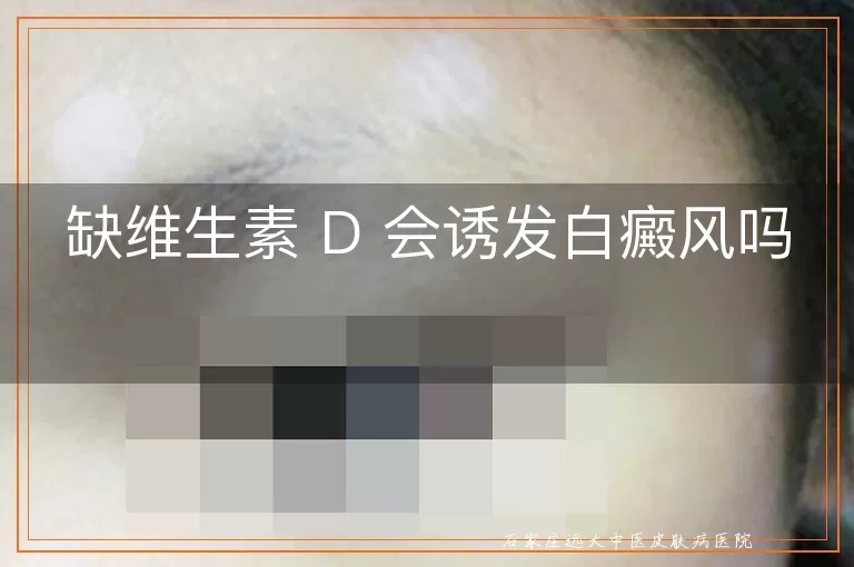 缺维生素 D 会诱发白癜风吗