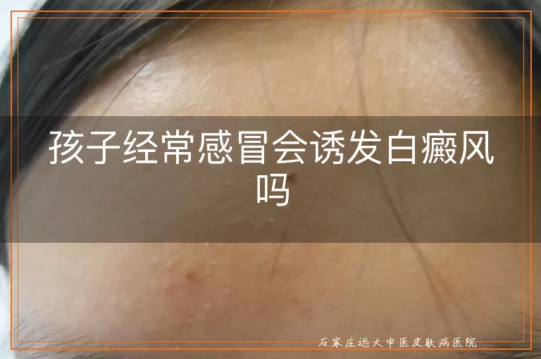 孩子经常感冒会诱发白癜风吗