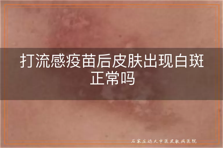 打流感疫苗后皮肤出现白斑正常吗