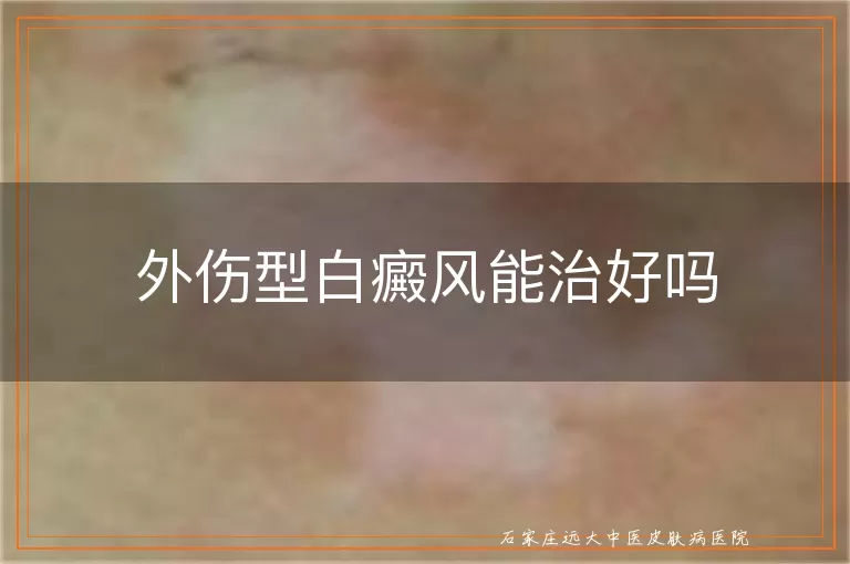 外伤型白癜风能治好吗
