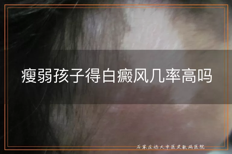 瘦弱孩子得白癜风几率高吗