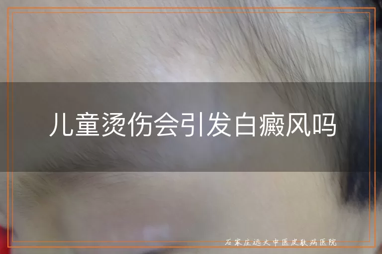 儿童烫伤会引发白癜风吗