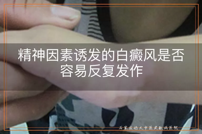 精神因素诱发的白癜风是否容易反复发作