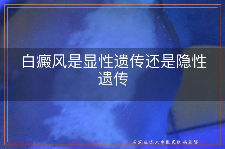 白癜风是显性遗传还是隐性遗传