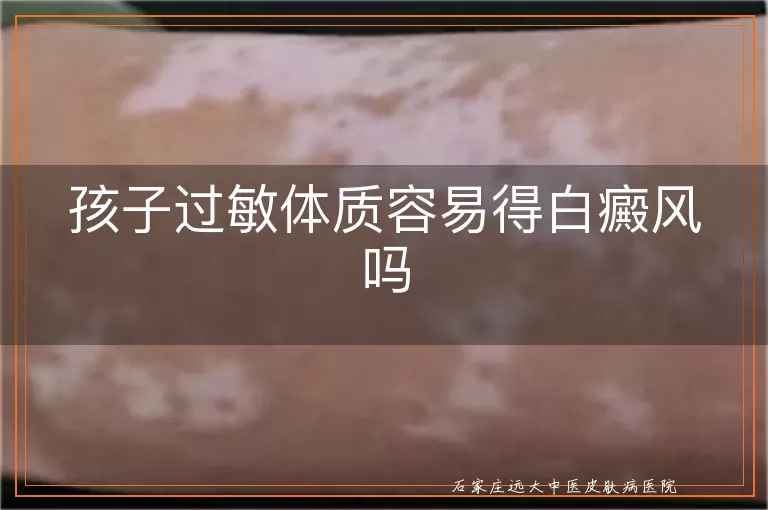 孩子过敏体质容易得白癜风吗