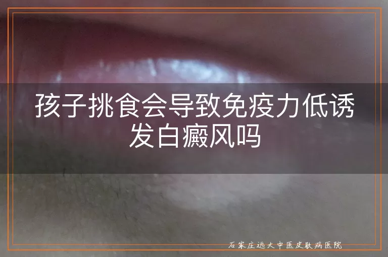 孩子挑食会导致免疫力低诱发白癜风吗