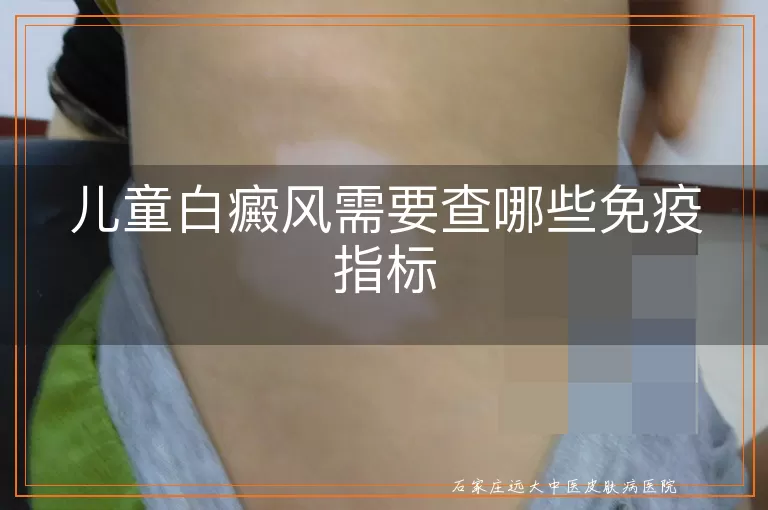 儿童白癜风需要查哪些免疫指标