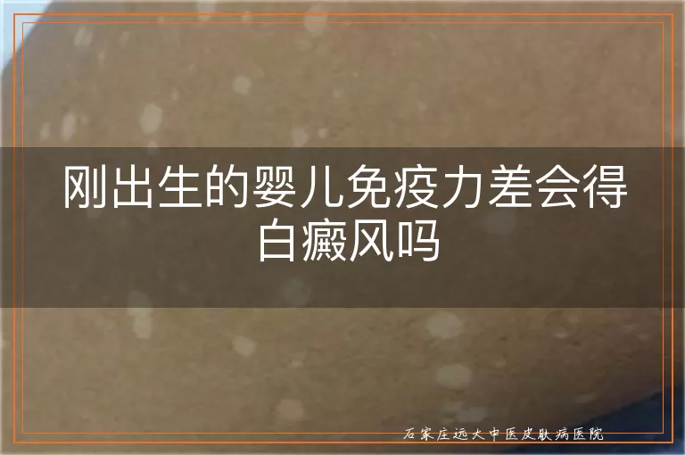刚出生的婴儿免疫力差会得白癜风吗