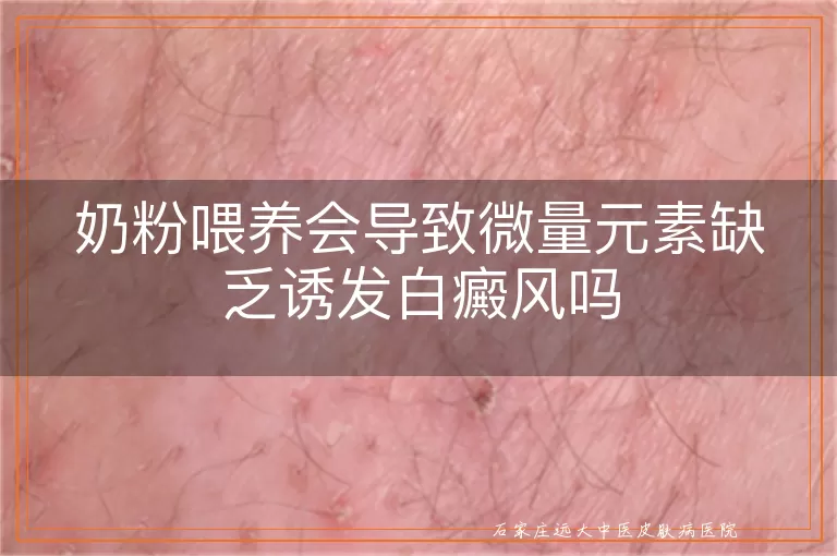 奶粉喂养会导致微量元素缺乏诱发白癜风吗