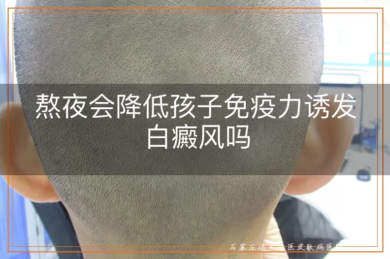 熬夜会降低孩子免疫力诱发白癜风吗