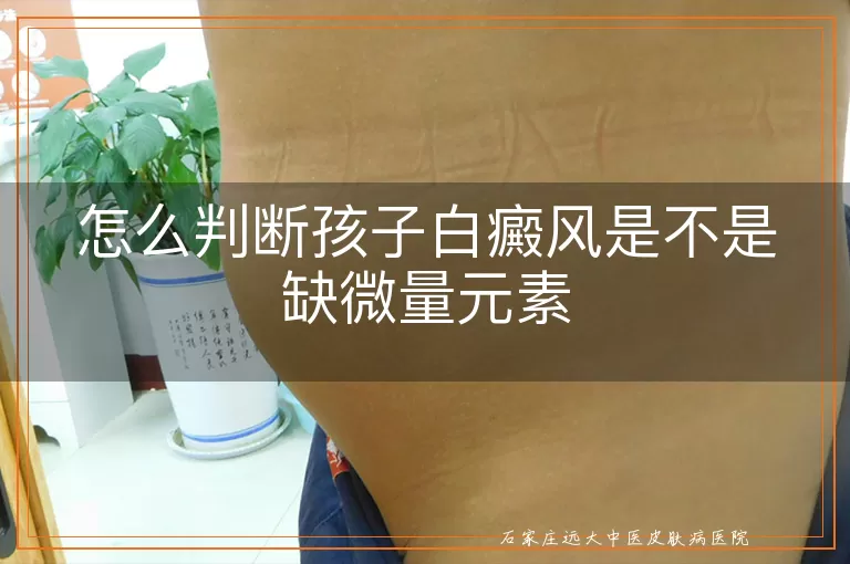 怎么判断孩子白癜风是不是缺微量元素