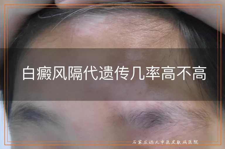 白癜风隔代遗传几率高不高