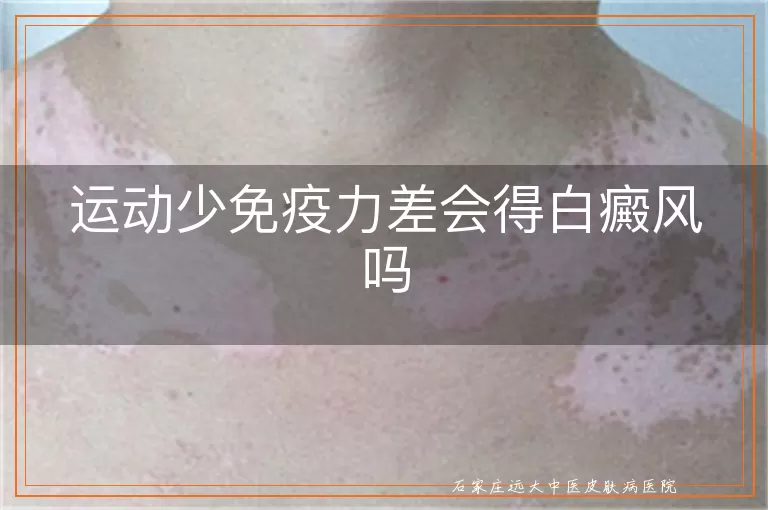 运动少免疫力差会得白癜风吗