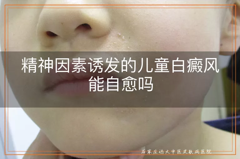 精神因素诱发的儿童白癜风能自愈吗