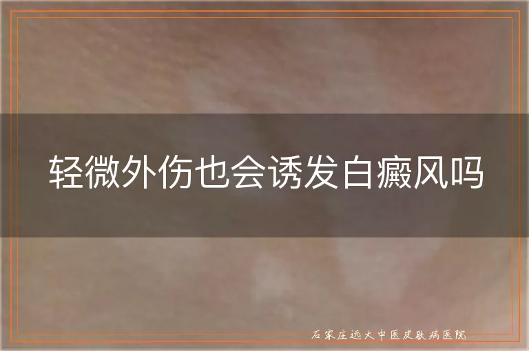 轻微外伤也会诱发白癜风吗