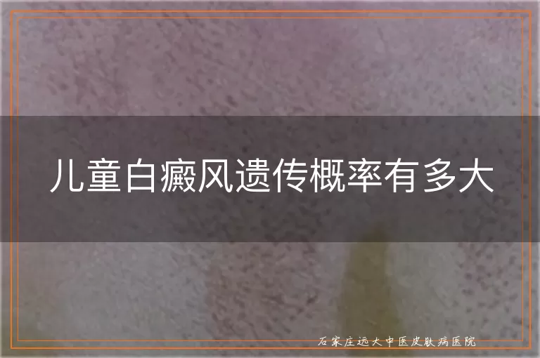 儿童白癜风遗传概率有多大