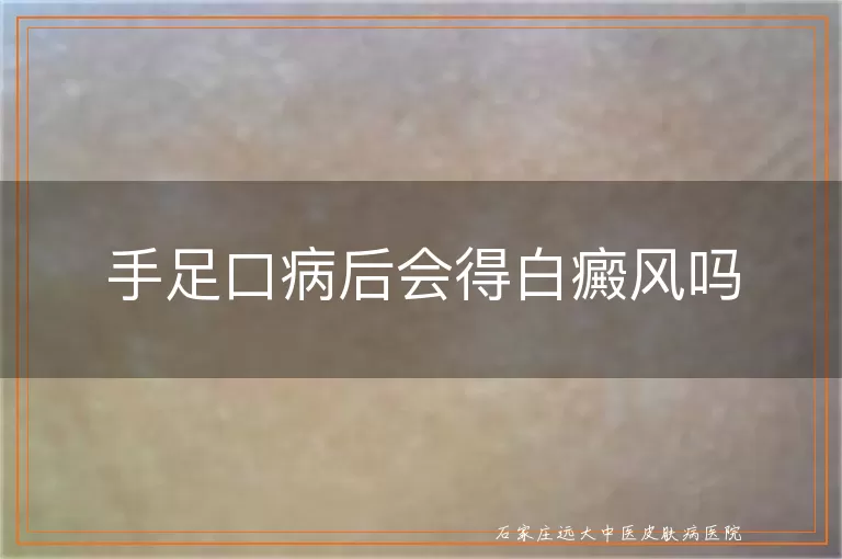 手足口病后会得白癜风吗
