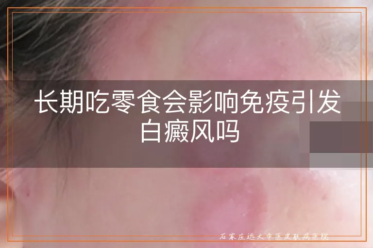 长期吃零食会影响免疫引发白癜风吗