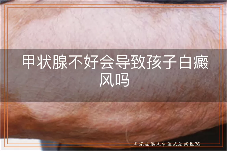 甲状腺不好会导致孩子白癜风吗