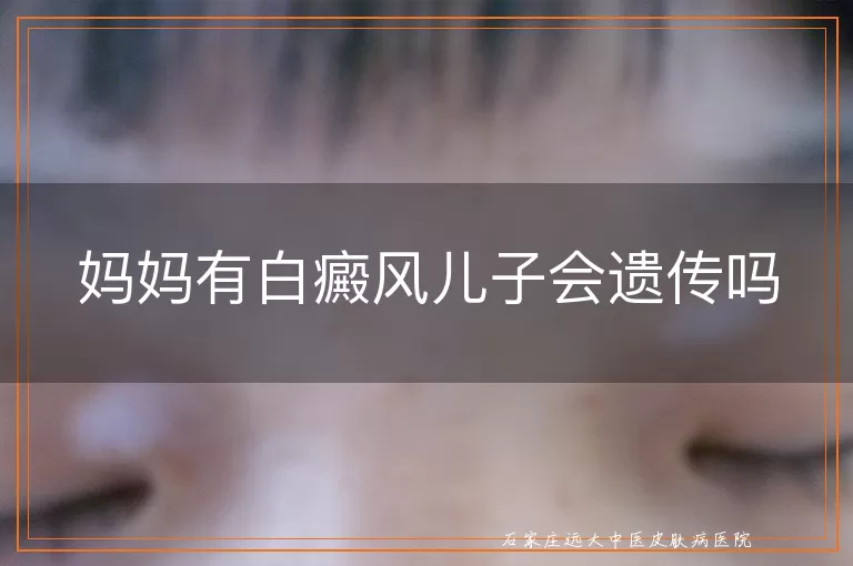 妈妈有白癜风儿子会遗传吗