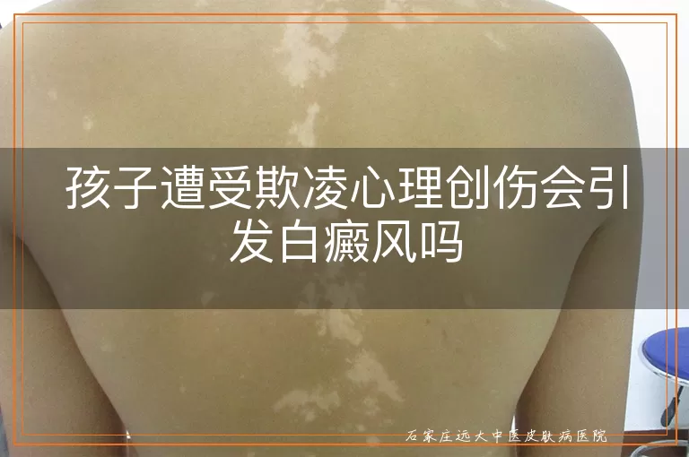 孩子遭受欺凌心理创伤会引发白癜风吗