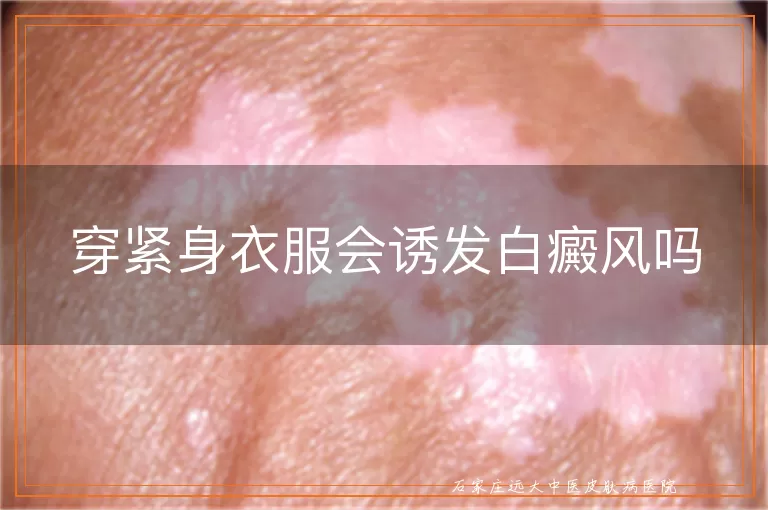穿紧身衣服会诱发白癜风吗