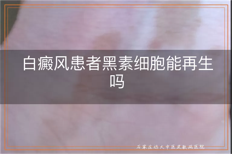 白癜风患者黑素细胞能再生吗