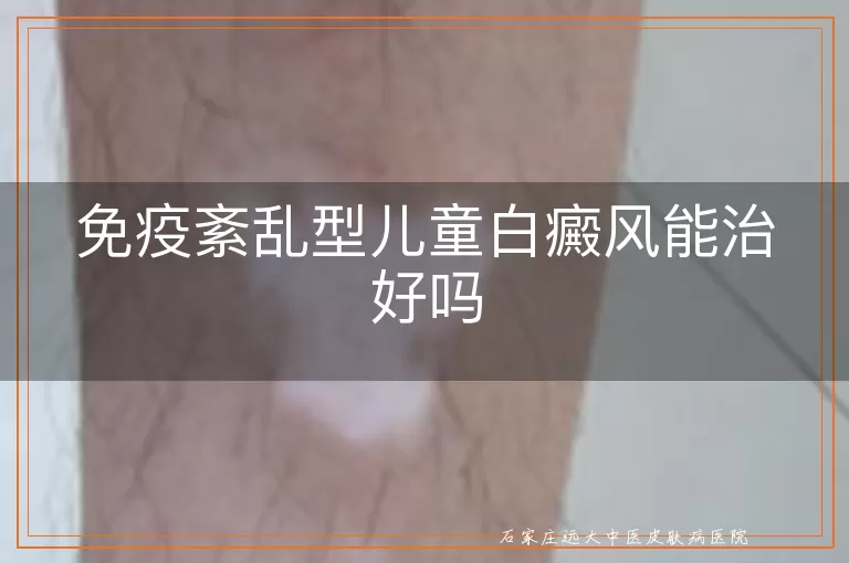 免疫紊乱型儿童白癜风能治好吗