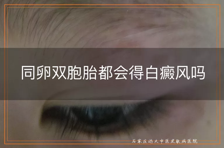 同卵双胞胎都会得白癜风吗