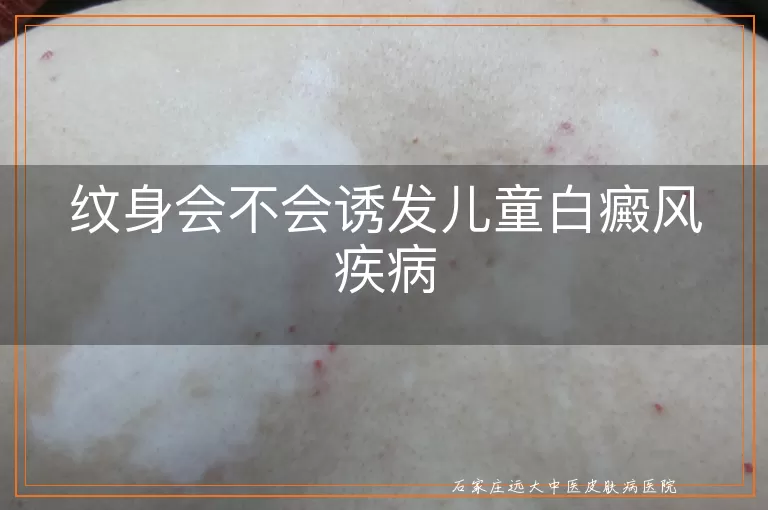 纹身会不会诱发儿童白癜风疾病
