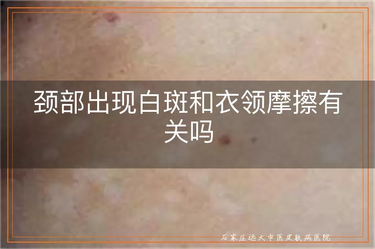 颈部出现白斑和衣领摩擦有关吗