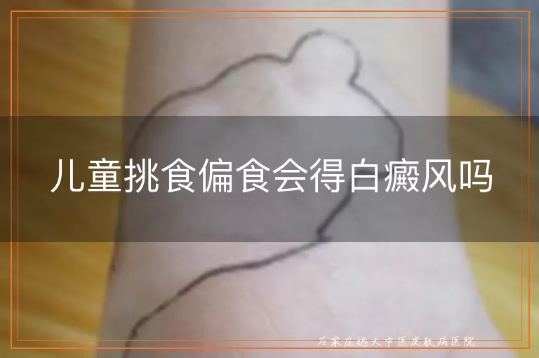儿童挑食偏食会得白癜风吗