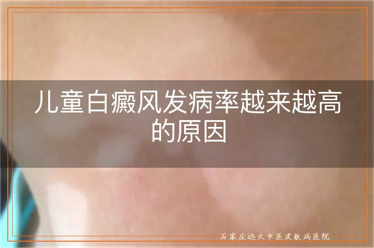 儿童白癜风发病率越来越高的原因