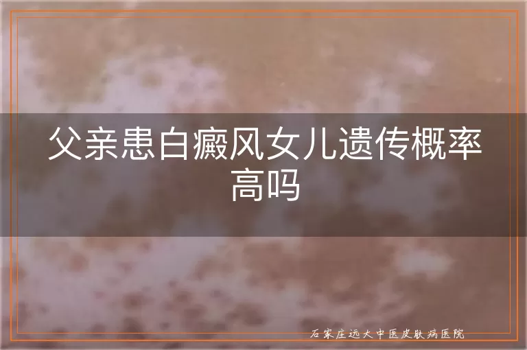 父亲患白癜风女儿遗传概率高吗