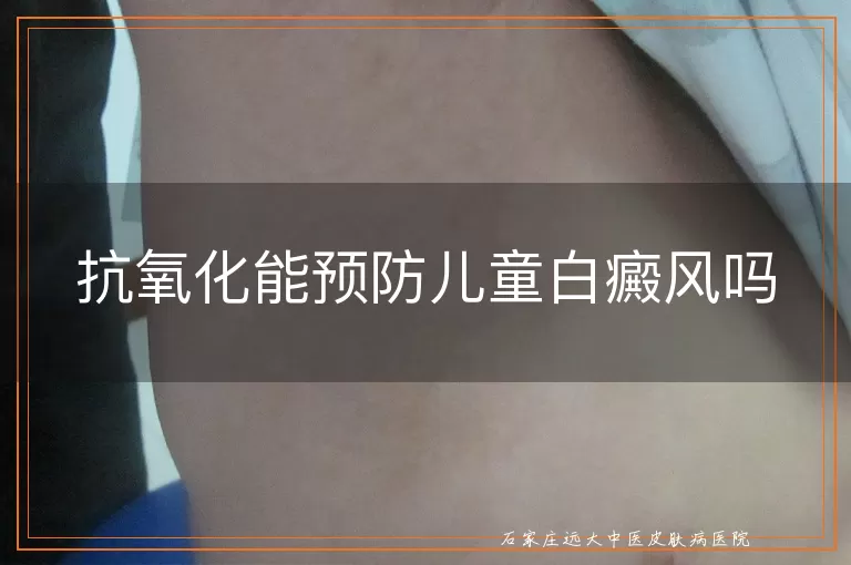 抗氧化能预防儿童白癜风吗