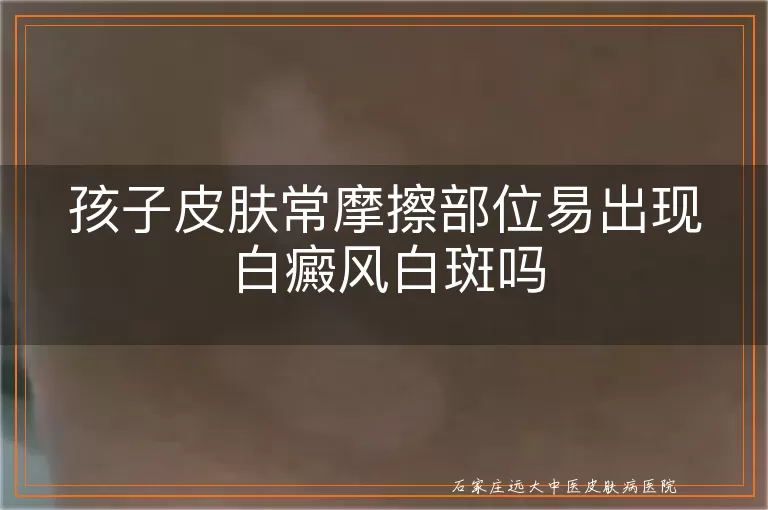 孩子皮肤常摩擦部位易出现白癜风白斑吗