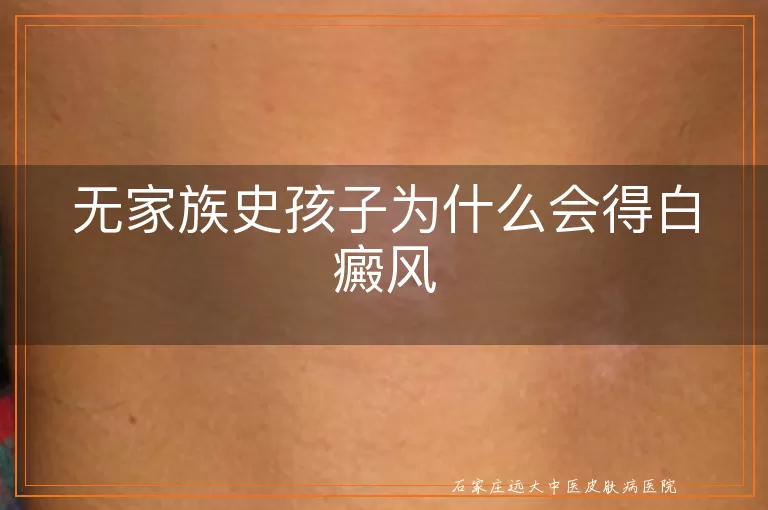 无家族史孩子为什么会得白癜风