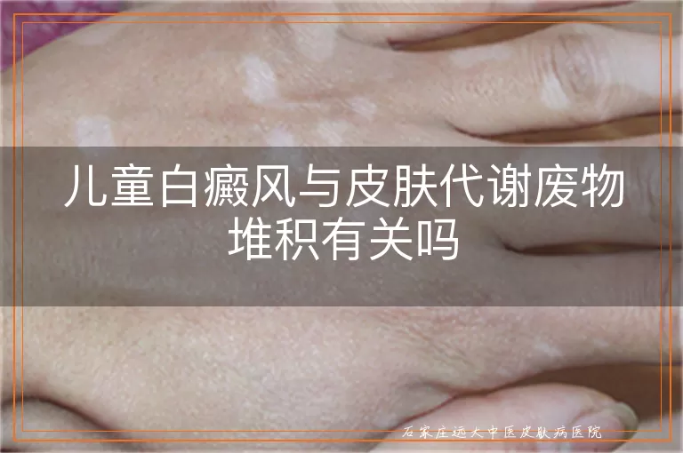 儿童白癜风与皮肤代谢废物堆积有关吗