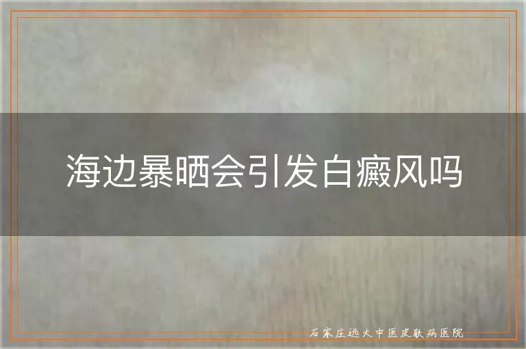 海边暴晒会引发白癜风吗