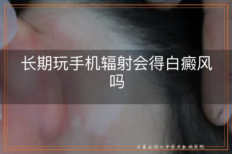 长期玩手机辐射会得白癜风吗