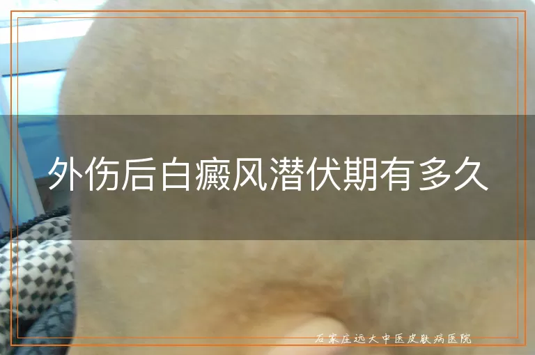 外伤后白癜风潜伏期有多久
