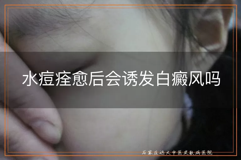 水痘痊愈后会诱发白癜风吗