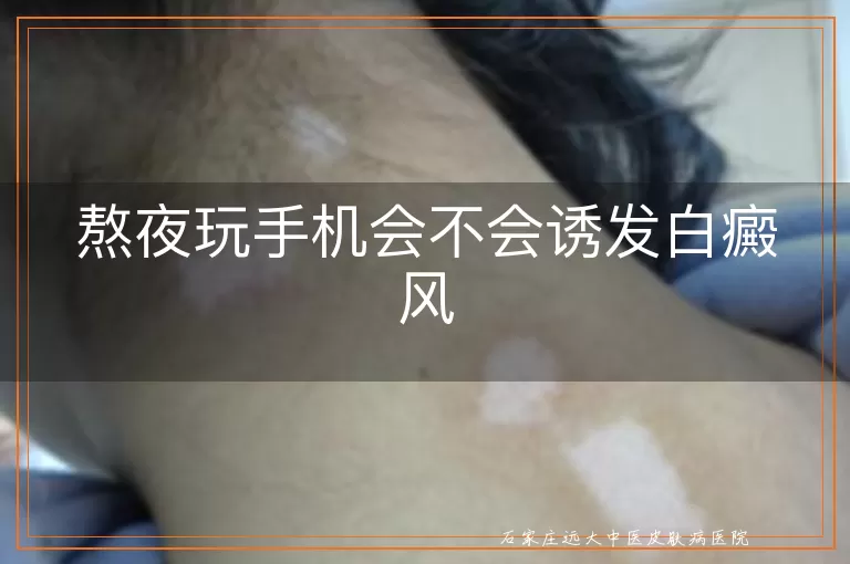 熬夜玩手机会不会诱发白癜风