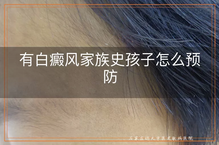 有白癜风家族史孩子怎么预防