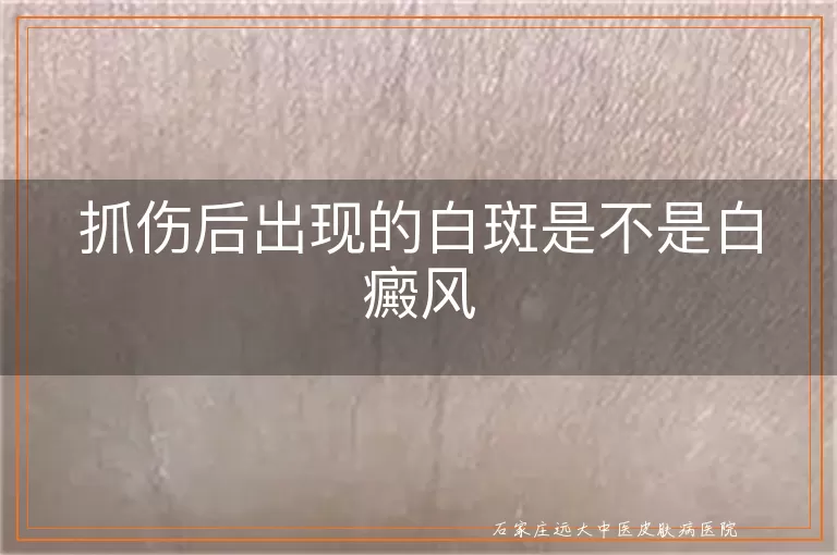 抓伤后出现的白斑是不是白癜风