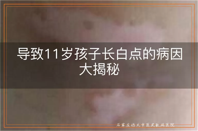 导致11岁孩子长白点的病因大揭秘